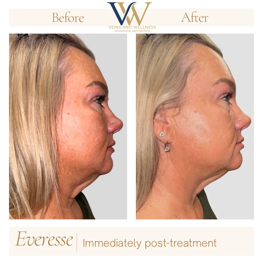 Everesse RF before and after at Veins and Wellness Las Vegas