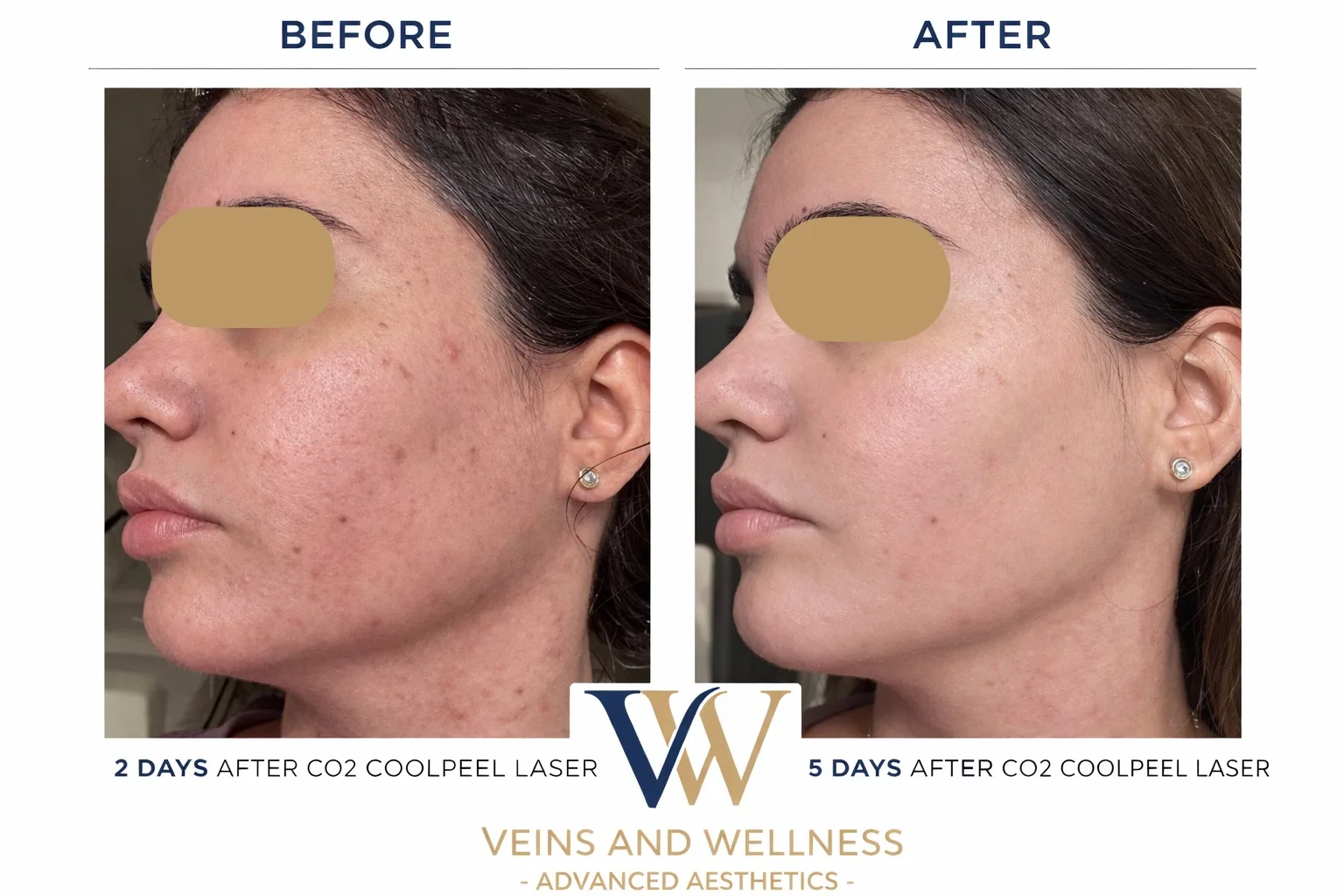 CoolPeel — 2 to 5 days after CO2 laser (Veins & Wellness)