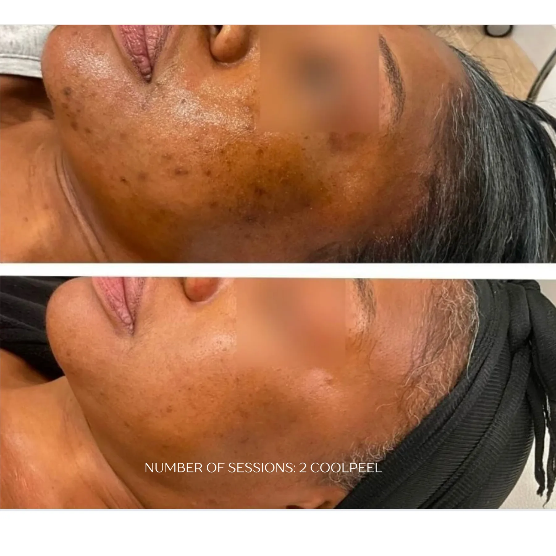 CoolPeel CO₂ before and after at Veins and Wellness Las Vegas