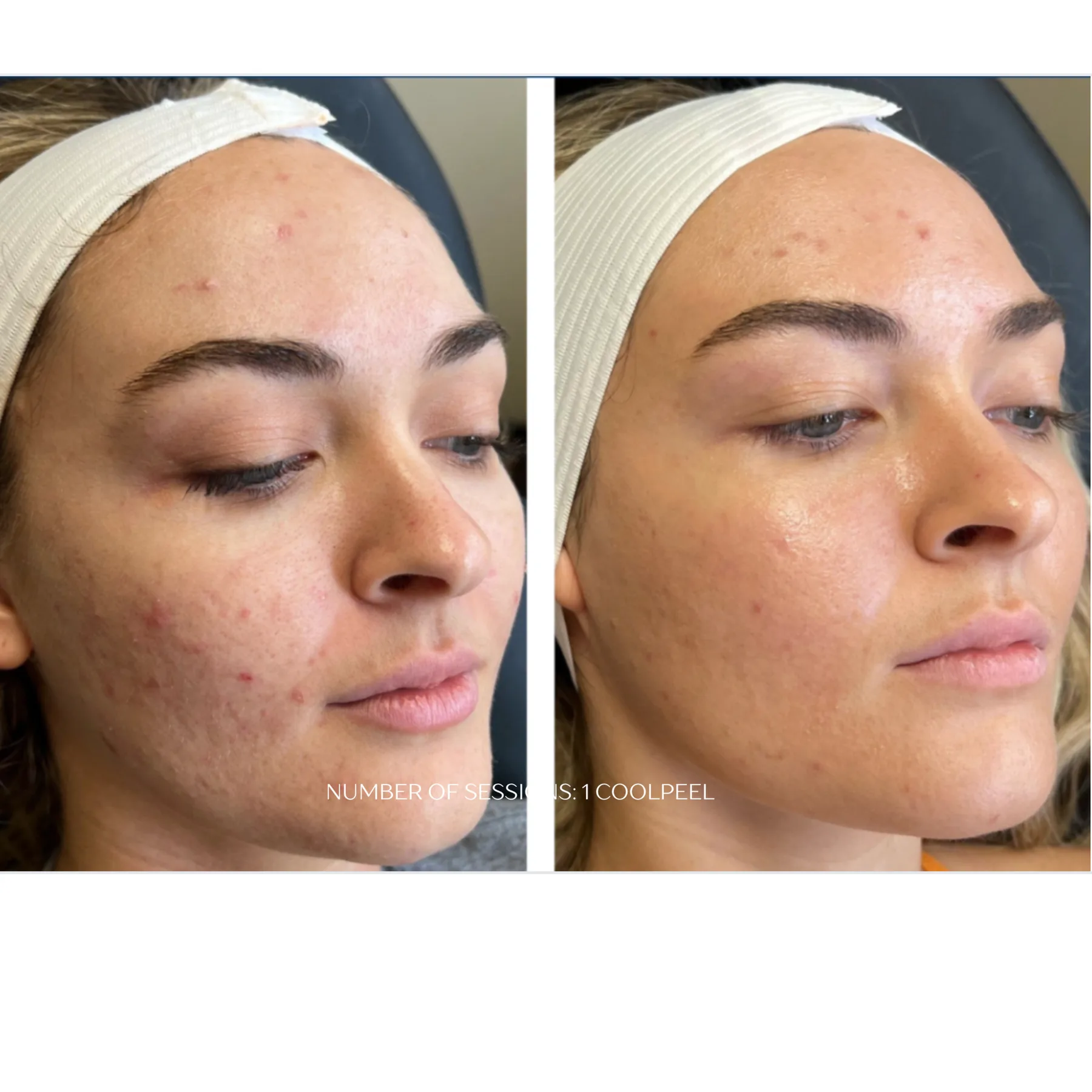 CoolPeel CO₂ before and after at Veins and Wellness Las Vegas