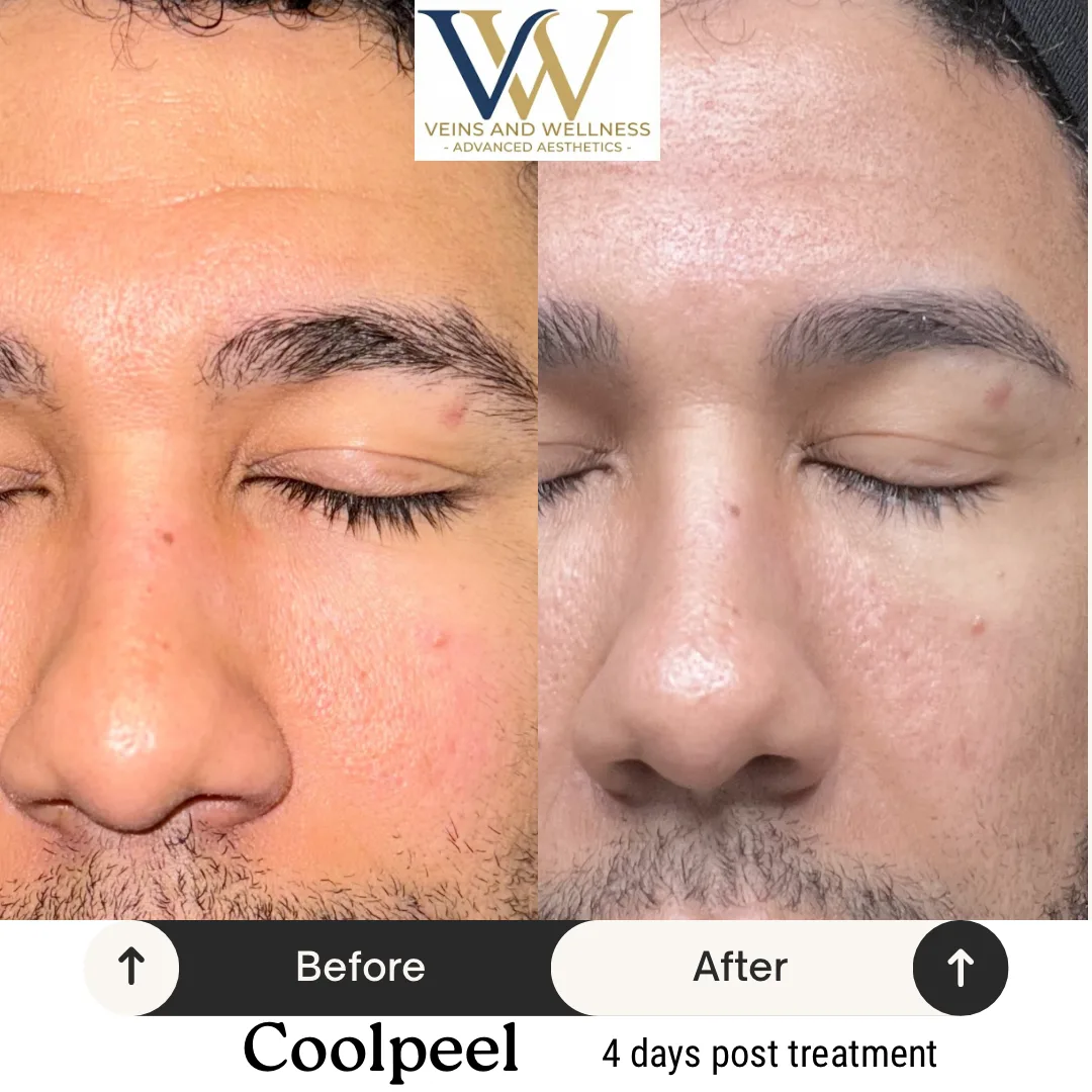 CoolPeel — 4 days post treatment (Veins & Wellness)