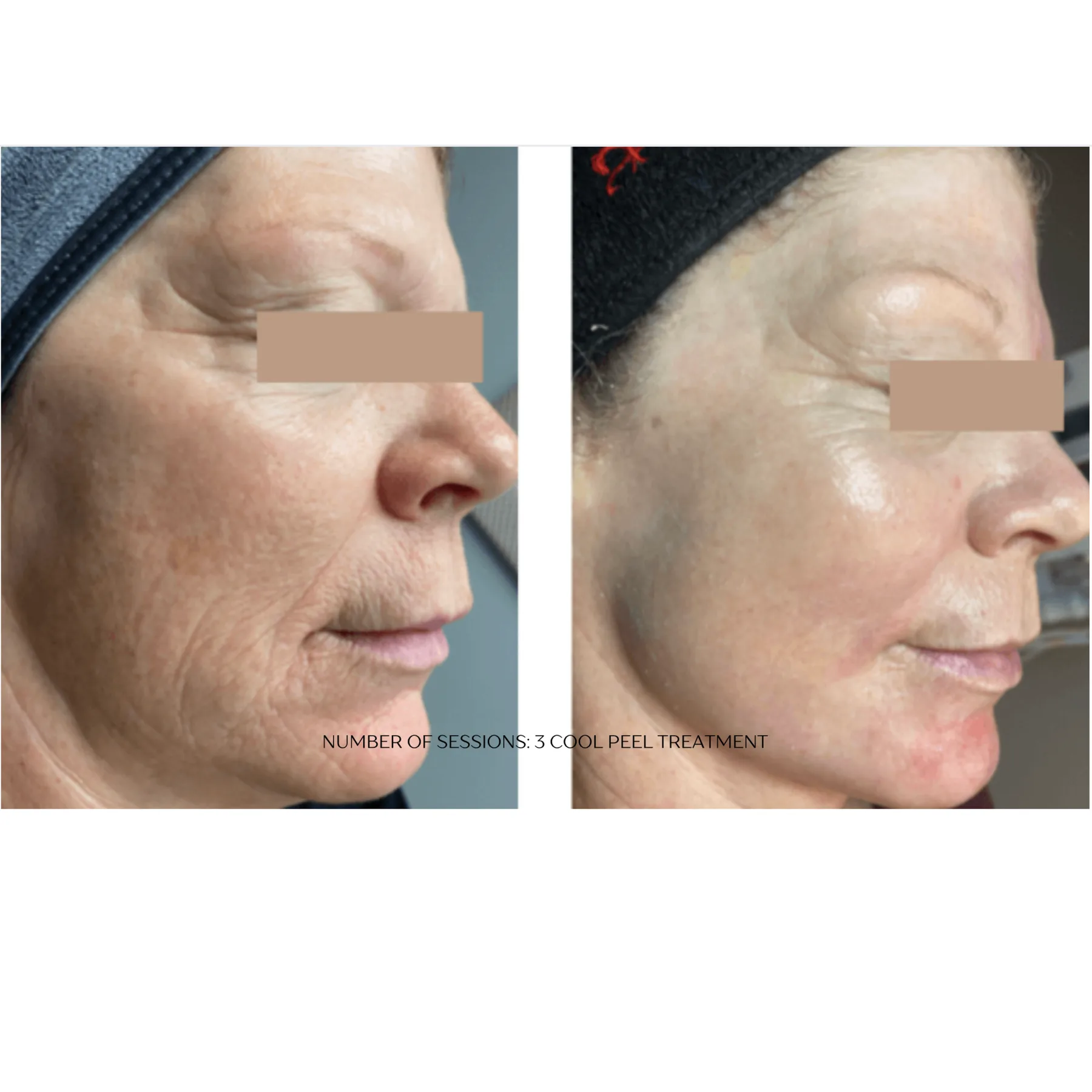 CoolPeel CO₂ before and after at Veins and Wellness Las Vegas