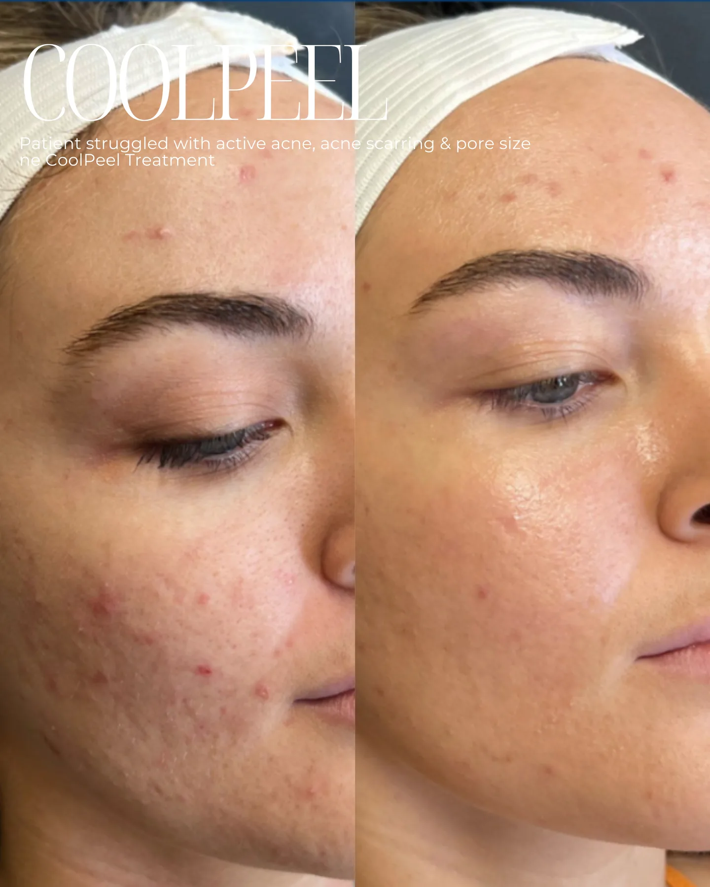 CoolPeel — active acne, scarring and pore size, before and after