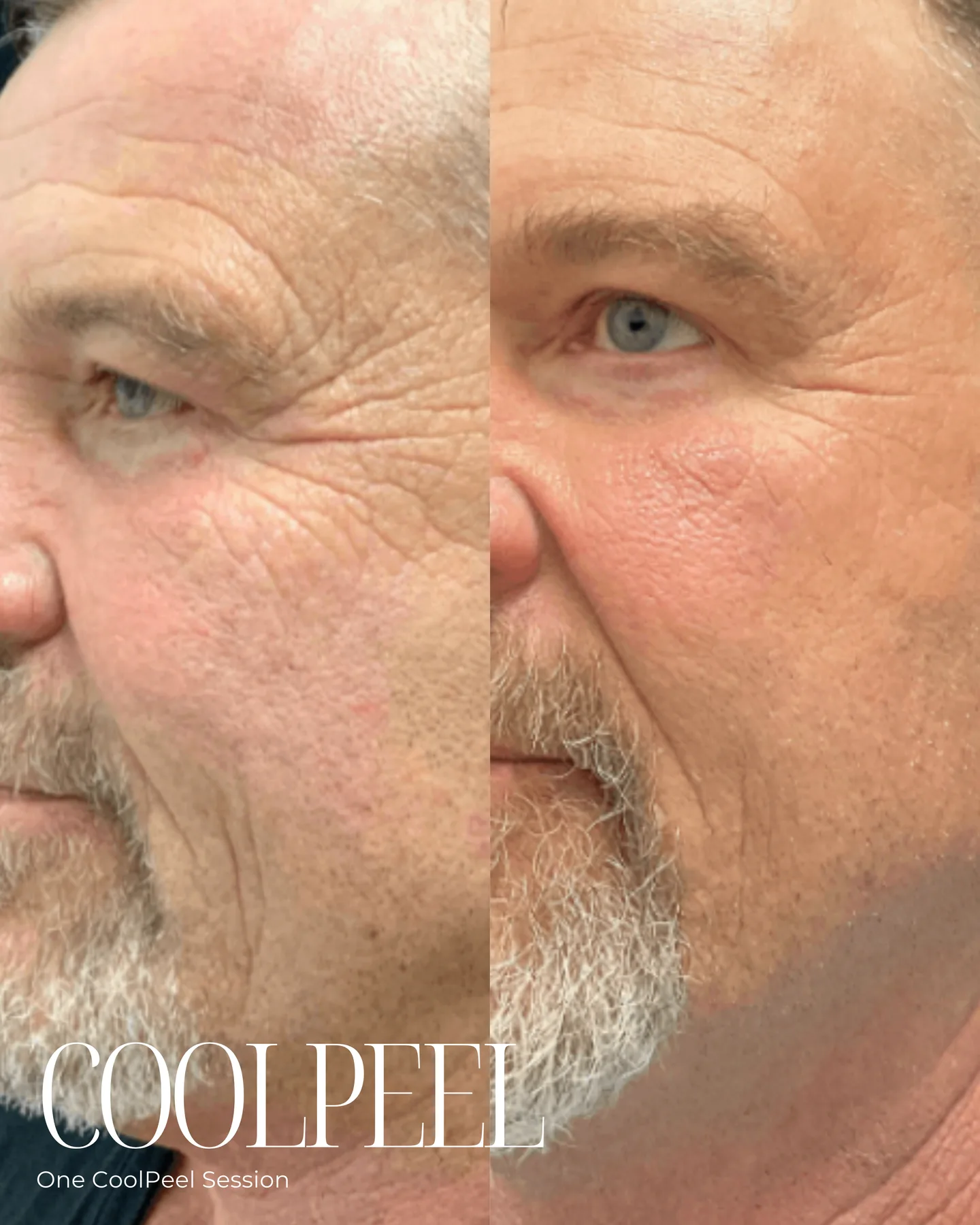 CoolPeel — pigmentation, 2 treatments, before and after