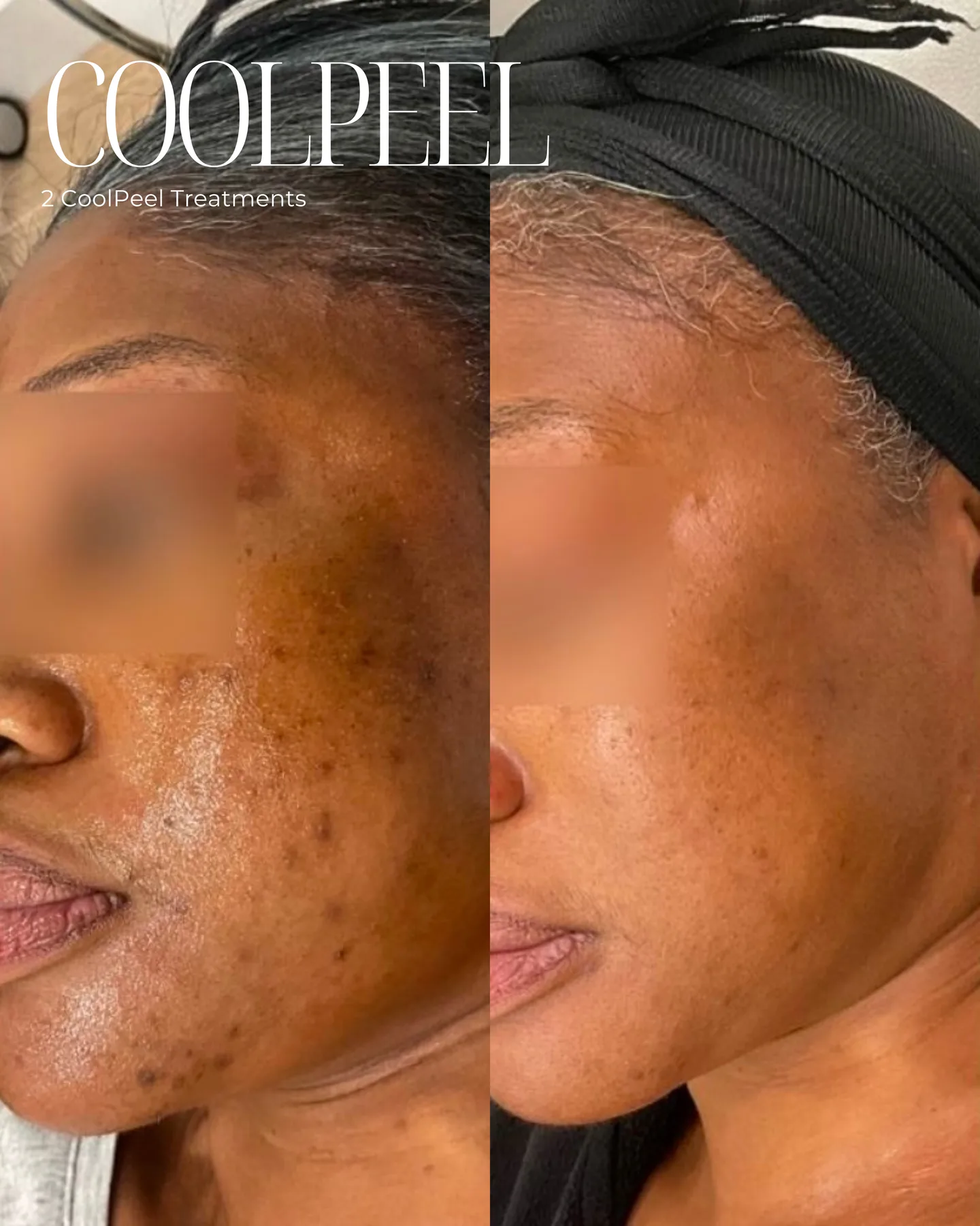 CoolPeel — wrinkles and texture, one session, before and after