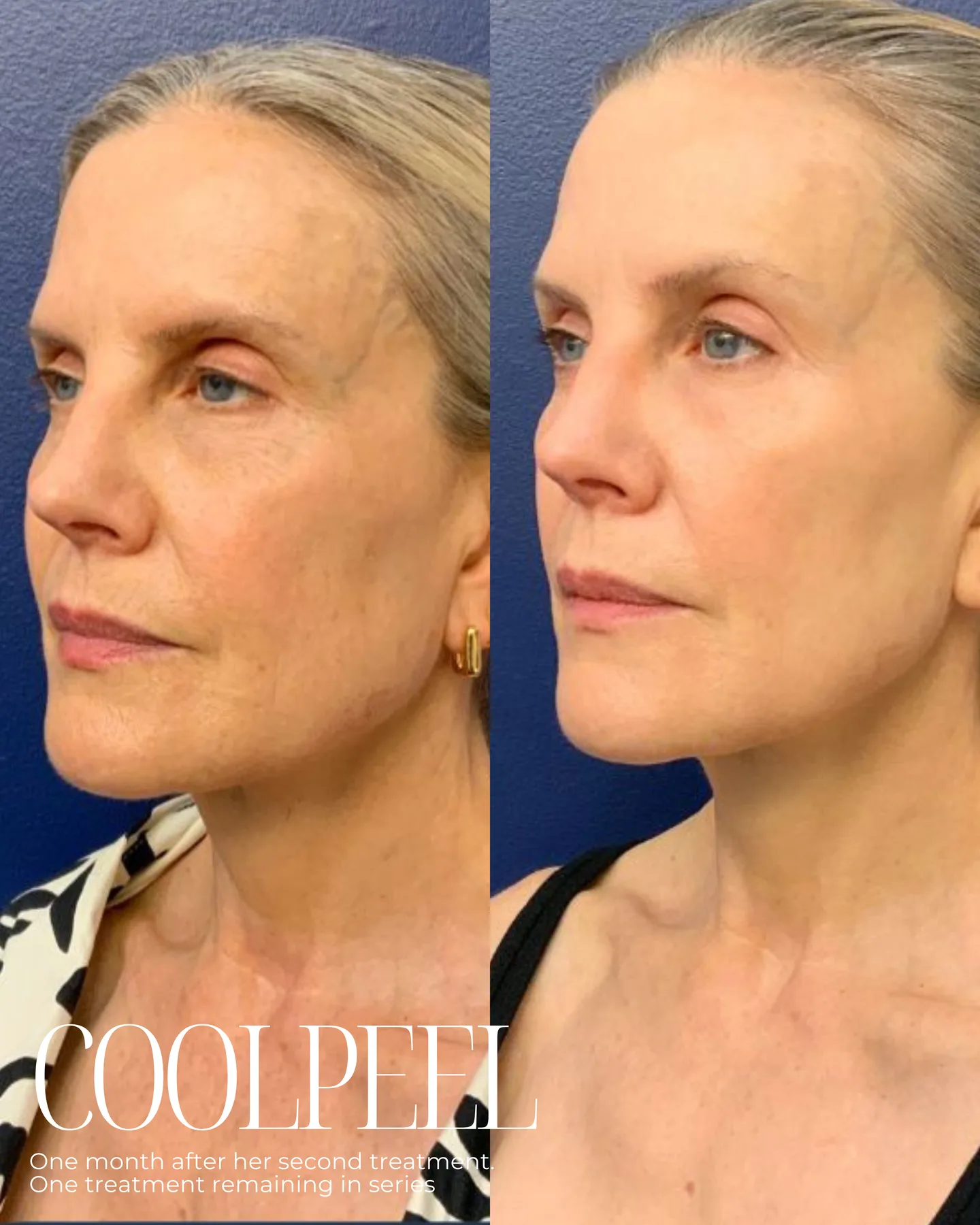 CoolPeel — one month after second treatment, before and after