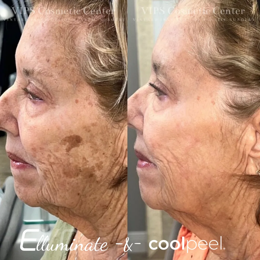 CoolPeel + Elluminate — sun damage and pigmentation, before and after