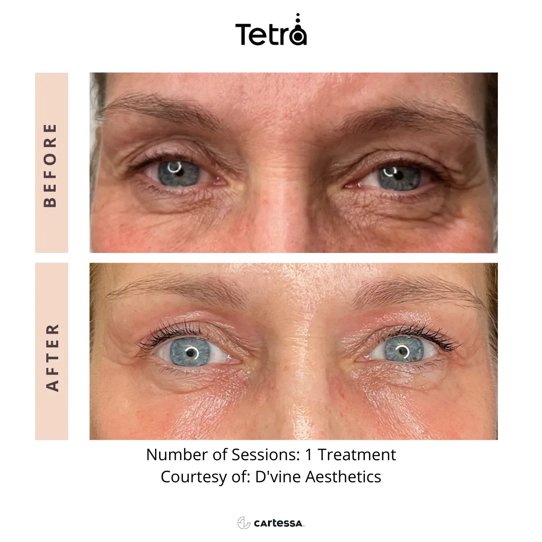 CoolPeel — eye area fine lines, 1 treatment, before and after