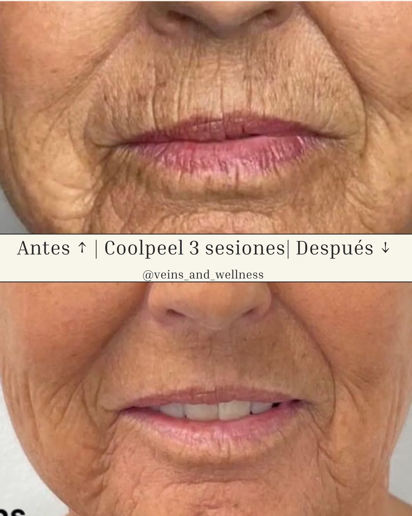 CoolPeel CO₂ before and after at Veins and Wellness Las Vegas