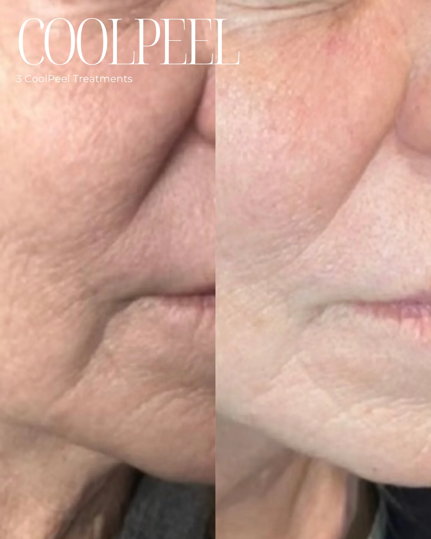 CoolPeel — 3 treatments, perioral lines, before and after