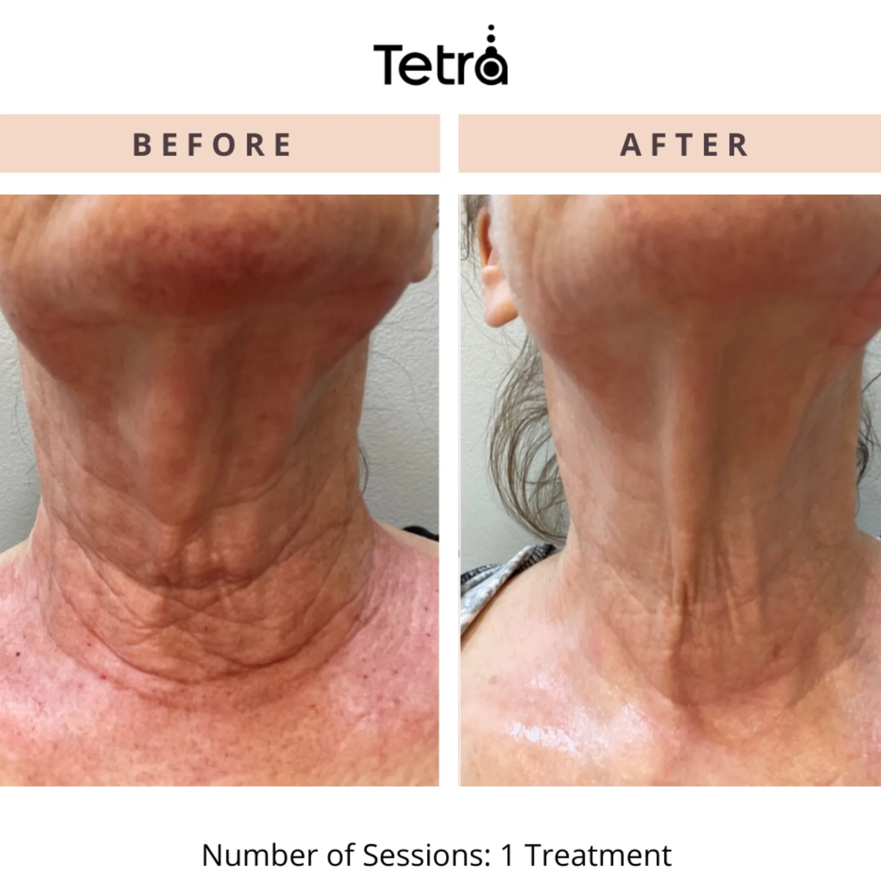 CoolPeel CO₂ before and after at Veins and Wellness Las Vegas