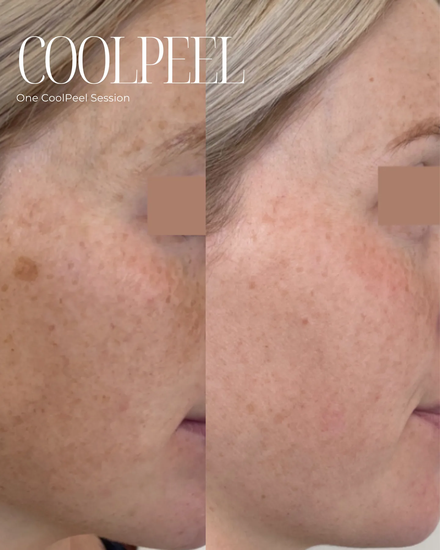 CoolPeel — one session, freckles and pigment, before and after