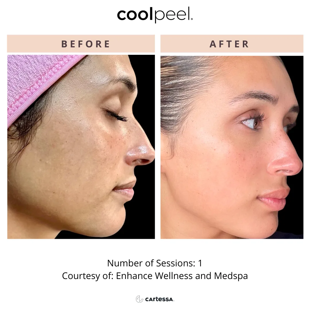 CoolPeel — texture and pores, 1 session, before and after