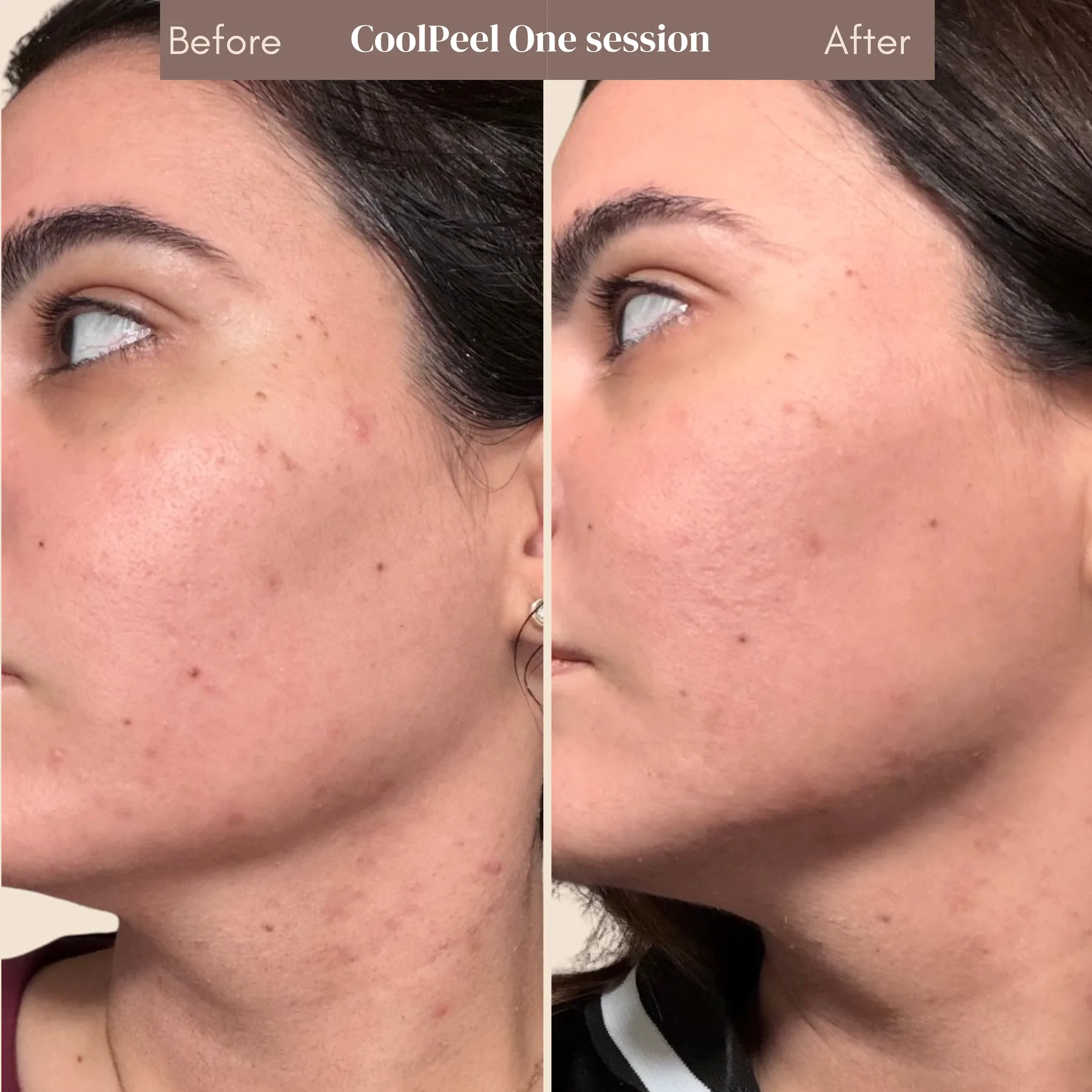 CoolPeel — one session, before and after (Veins & Wellness)