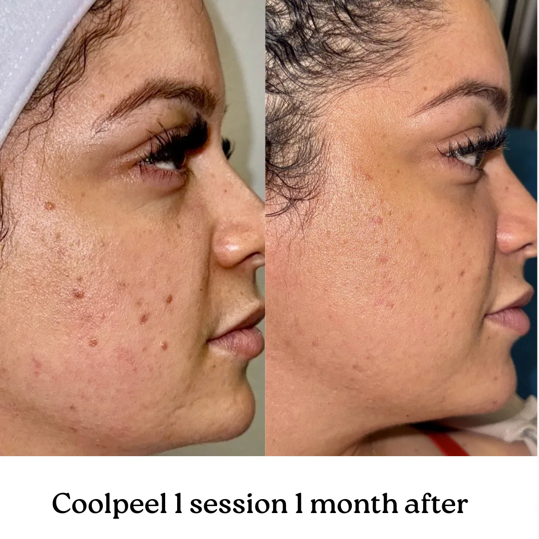 CoolPeel — 1 session, 1 month after, profile (Veins & Wellness)