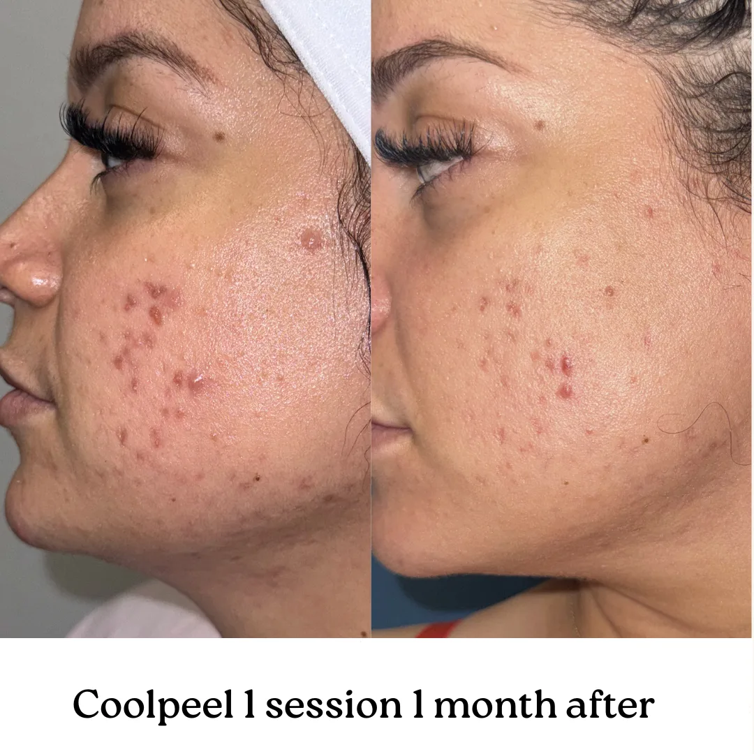 CoolPeel — 1 session, 1 month after, cheek and jaw (Veins & Wellness)