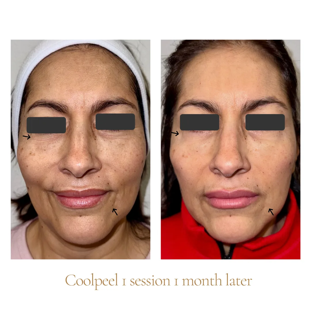 CoolPeel — 1 session, 1 month later, front view (Veins & Wellness)