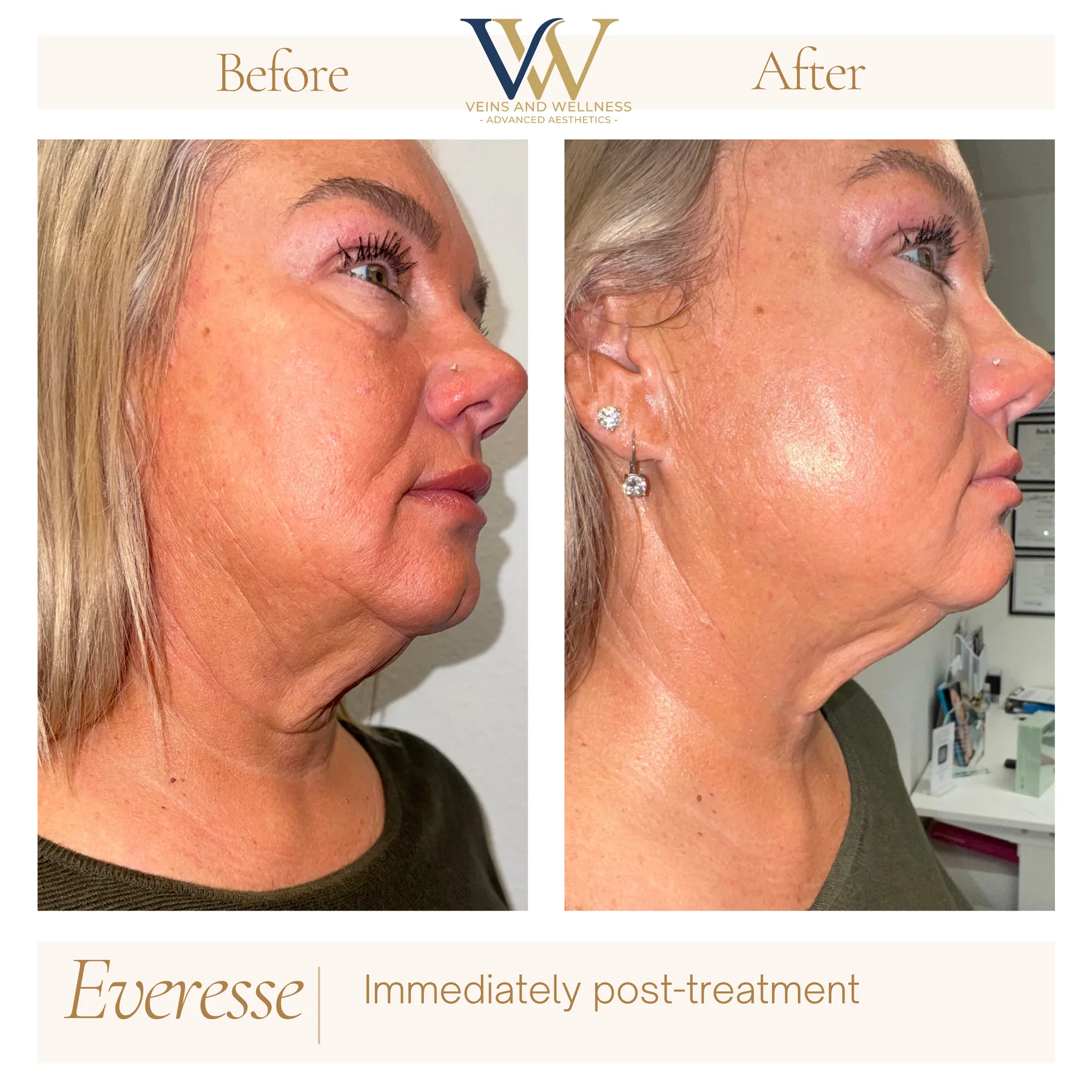 Everesse RF before and after at Veins and Wellness Las Vegas