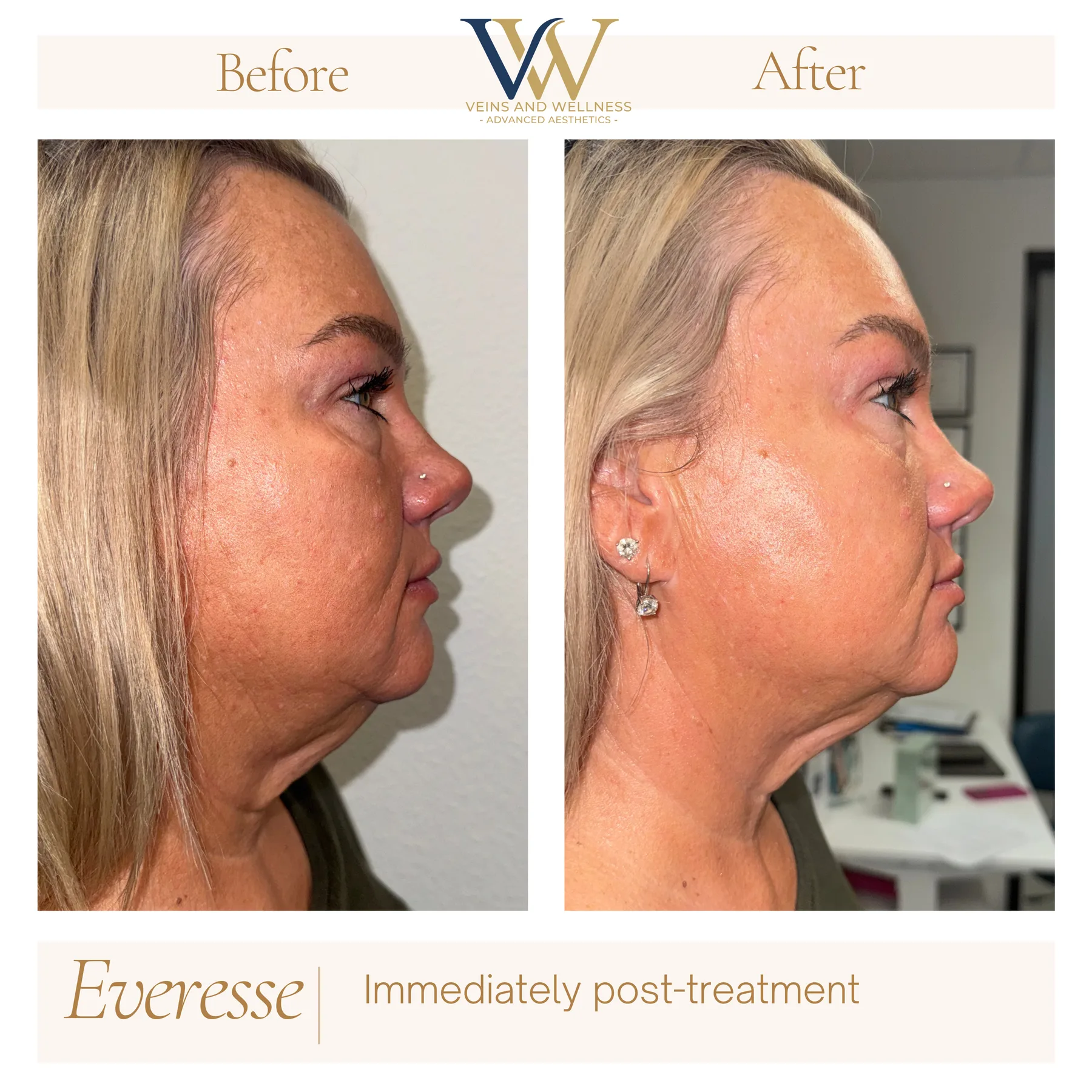 Everesse RF before and after at Veins and Wellness Las Vegas