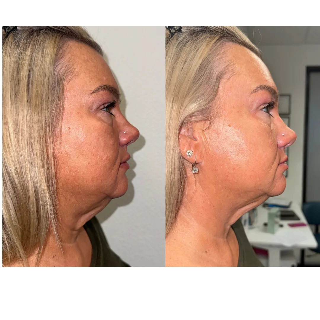 Everesse RF — profile jawline and neck, before and after