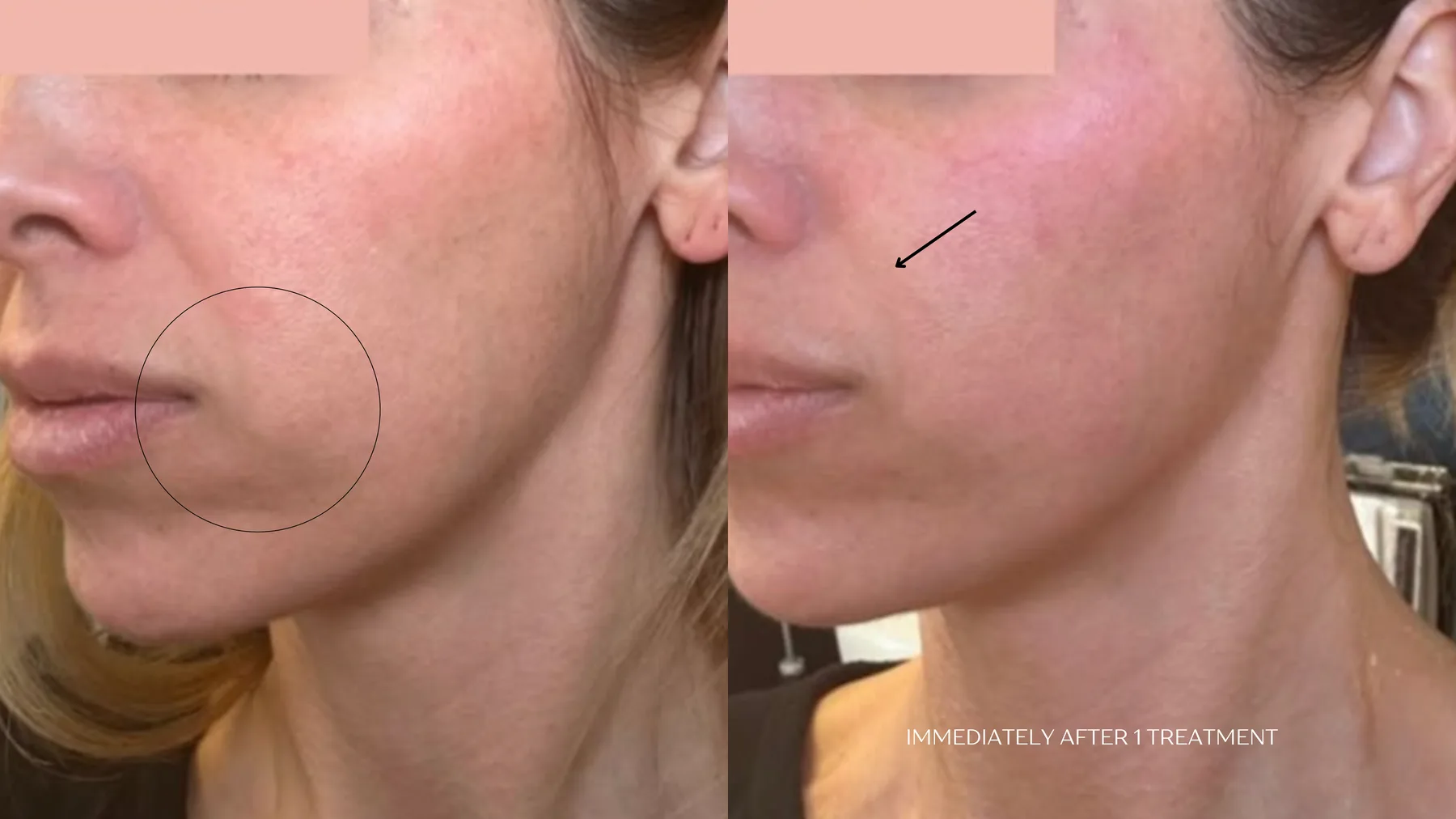 Everesse RF — jawline tightening, immediately after 1 treatment