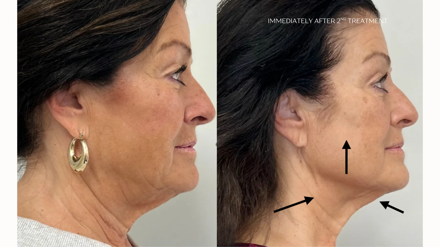Everesse RF — neck and jawline, immediately after 2nd treatment