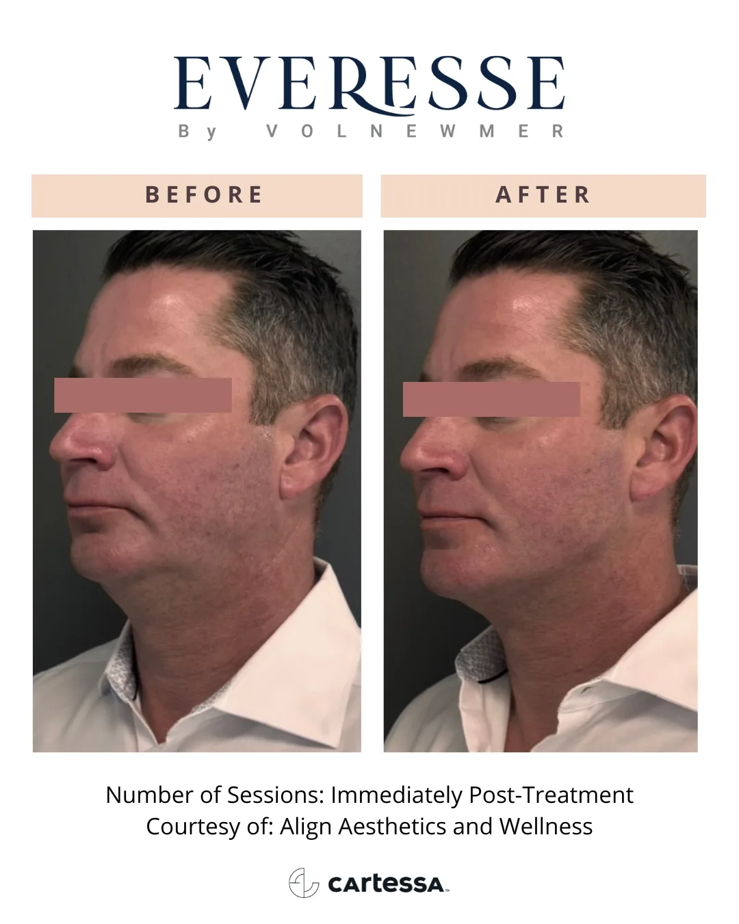 Everesse by Volnewmer — male patient, immediately post-treatment (courtesy Align Aesthetics and Wellness)