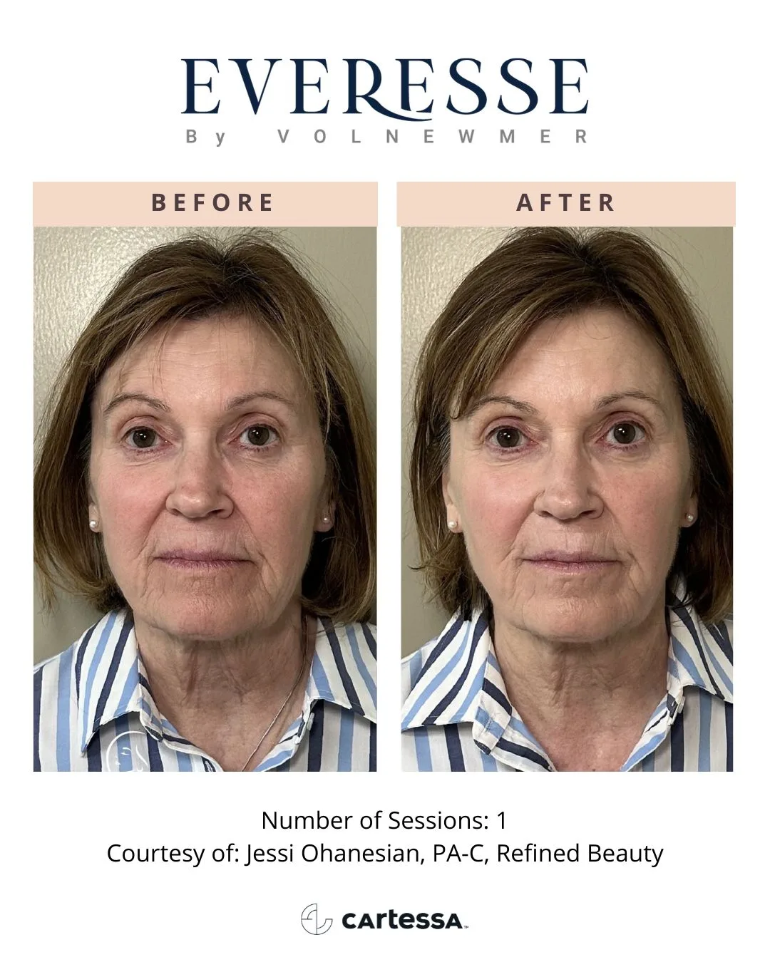 Everesse by Volnewmer — 1 session (courtesy Jessi Ohanesian, PA-C, Refined Beauty)
