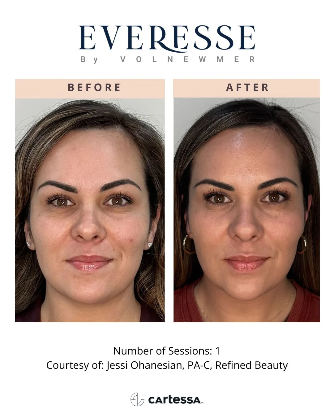 Everesse by Volnewmer — 1 session (courtesy Jessi Ohanesian, PA-C, Refined Beauty)