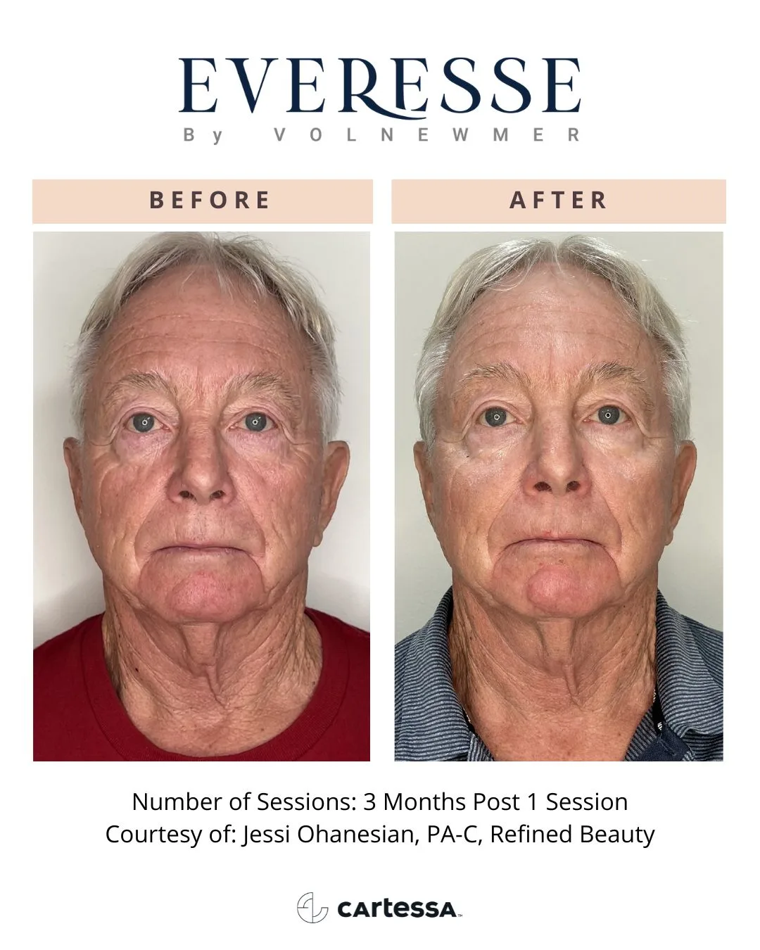 Everesse by Volnewmer — 3 months post 1 session (courtesy Jessi Ohanesian, PA-C, Refined Beauty)