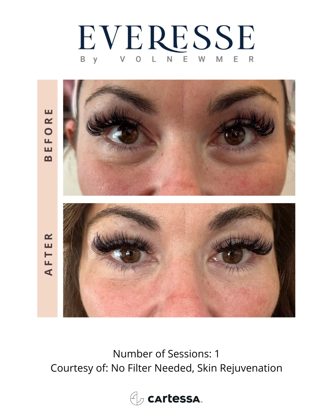 Everesse by Volnewmer — under-eye rejuvenation, 1 session (courtesy No Filter Needed, Skin Rejuvenation)