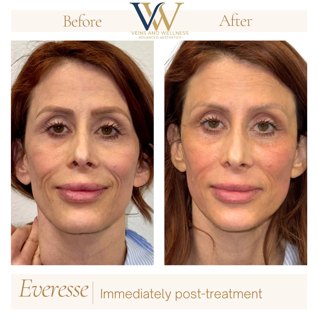 Everesse RF — front view, immediately post-treatment