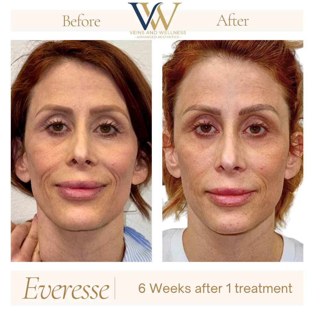 Everesse RF — profile, immediately post-treatment