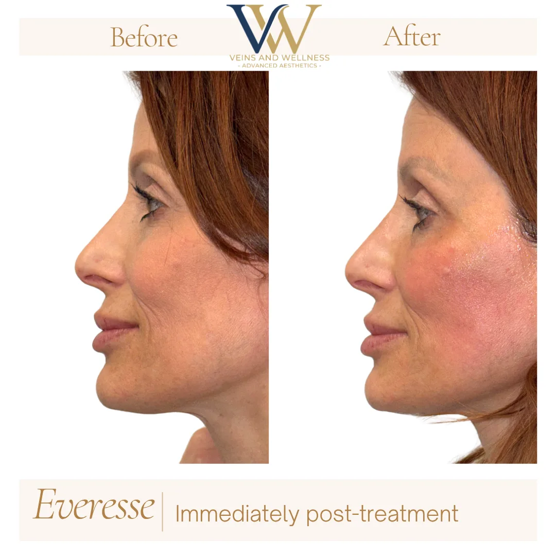 Everesse RF — three-quarter view, immediately post-treatment