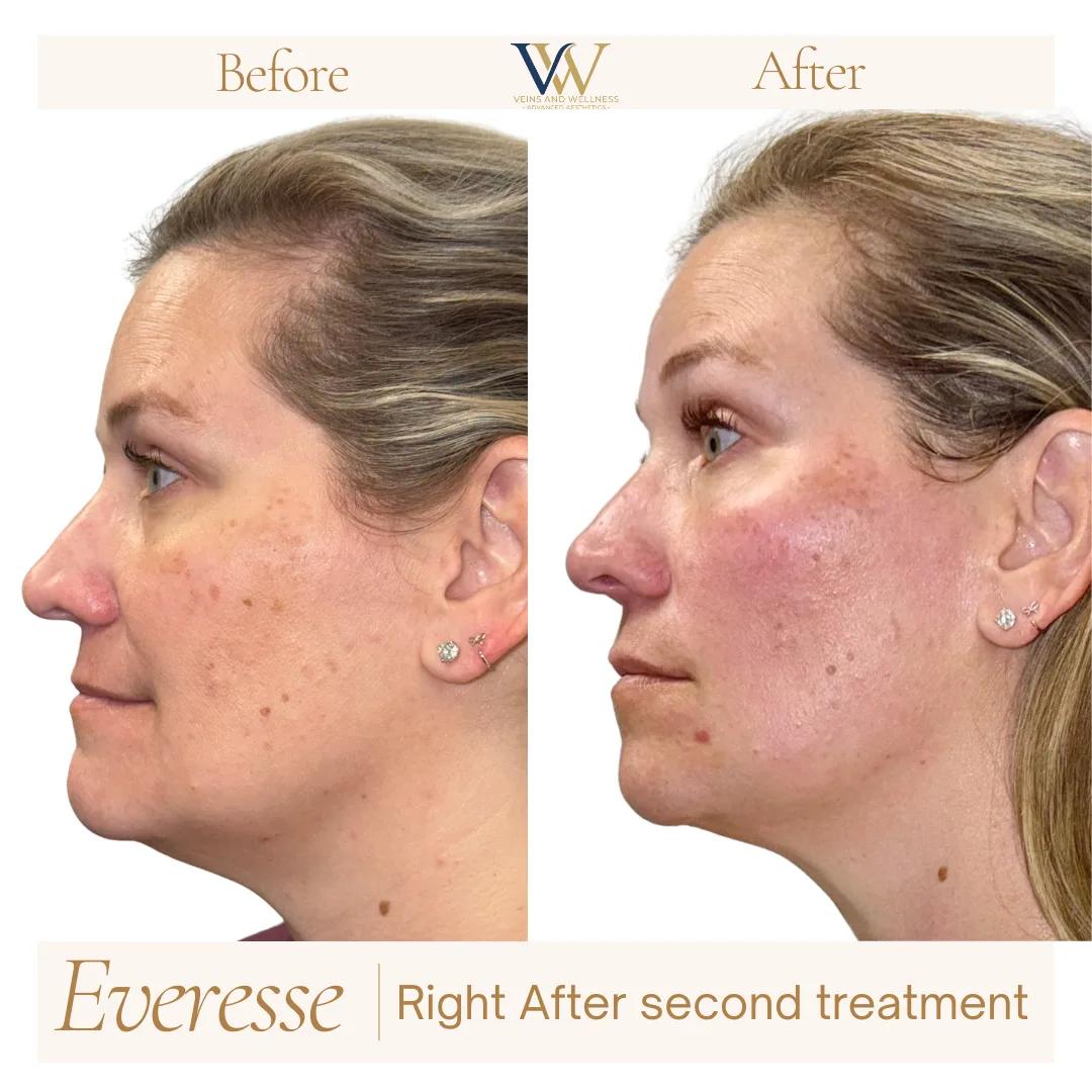 Everesse RF — 6 weeks after 1 treatment