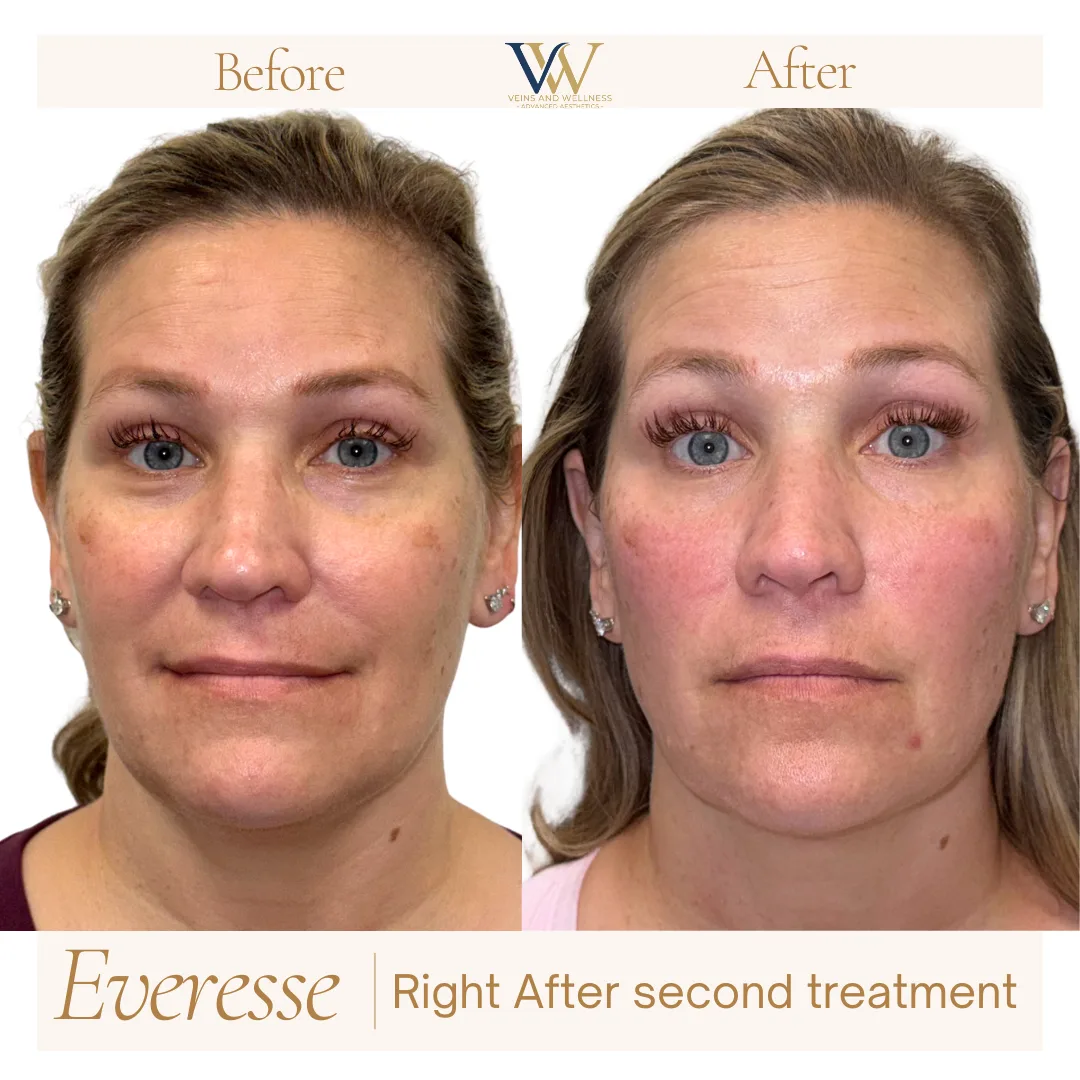 Everesse RF — profile, right after second treatment