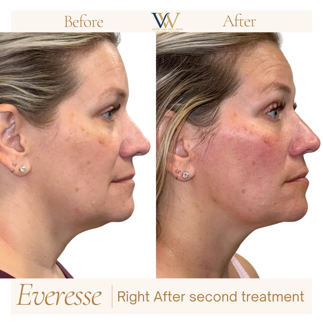 Everesse RF — front view, right after second treatment