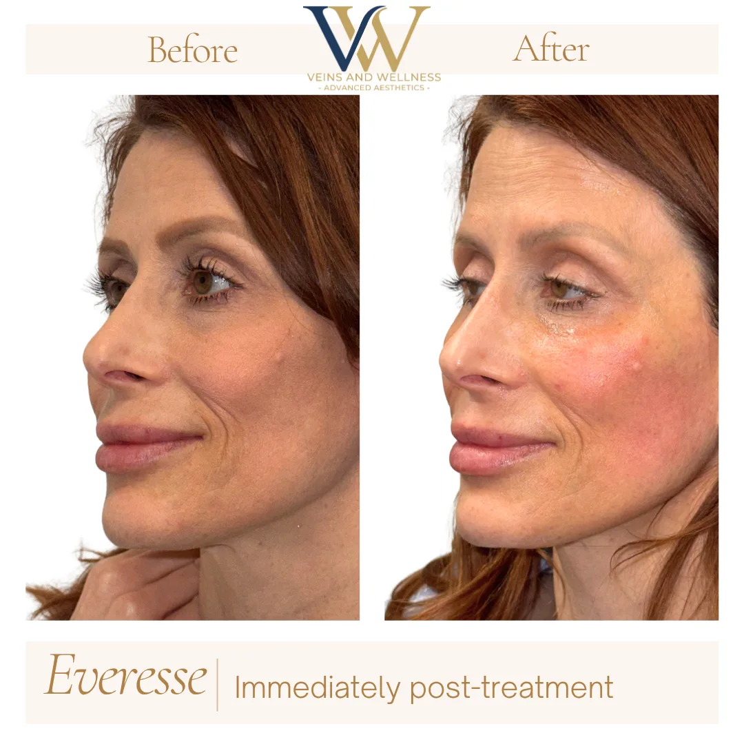 Everesse RF — side profile, right after second treatment