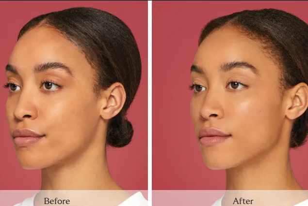 SKINVIVE — full face, before and after