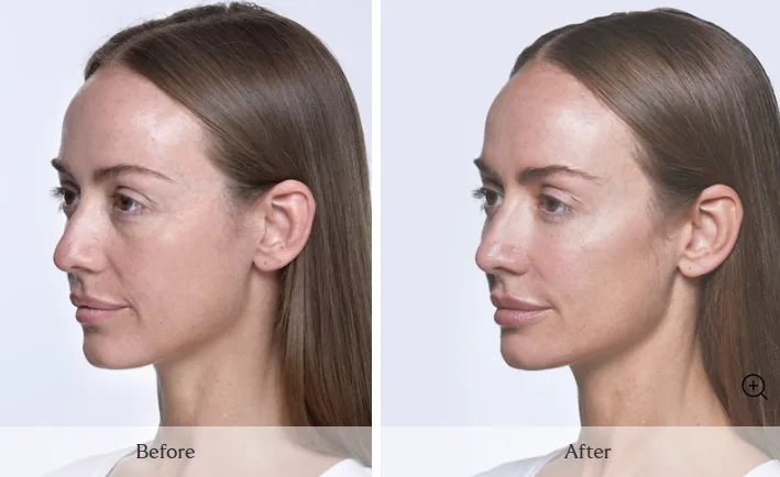 SKINVIVE — profile, before and after
