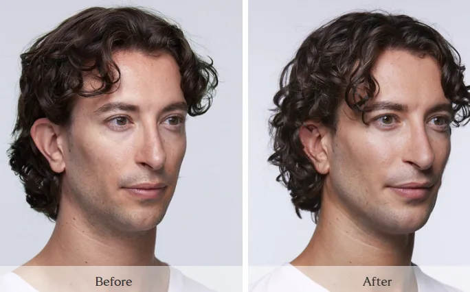 SKINVIVE — three-quarter view, before and after
