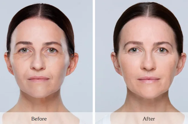 SKINVIVE — full face, before and after