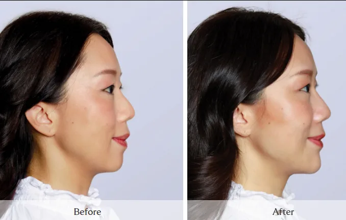 SKINVIVE — profile, before and after