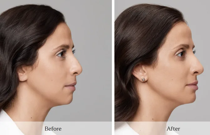 SKINVIVE — profile, before and after