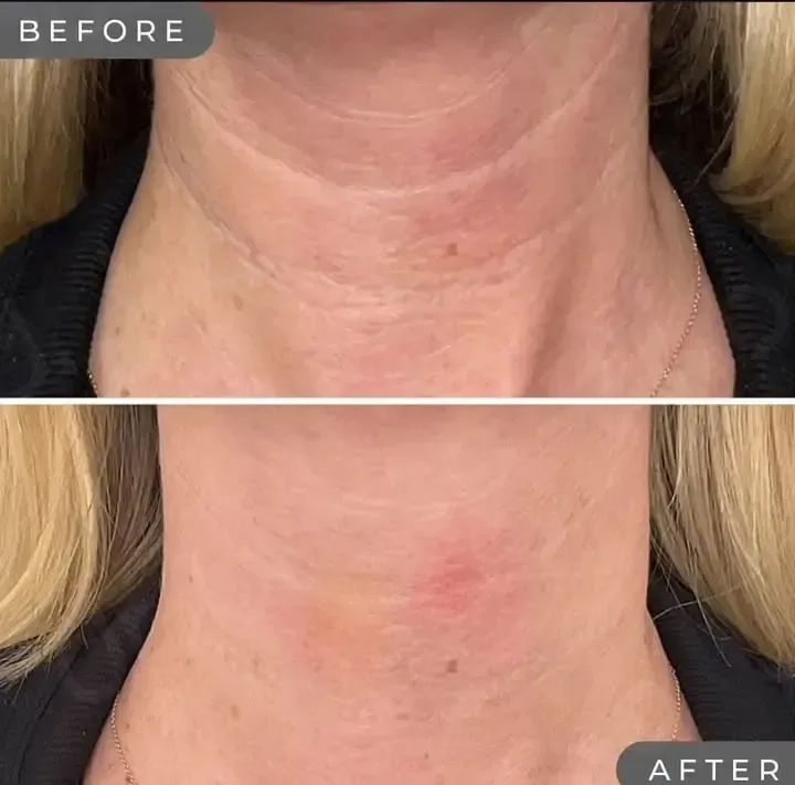 SKINVIVE — neck hydration and texture, before and after