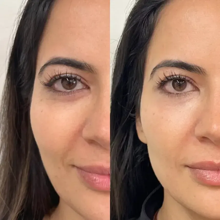 SKINVIVE — under-eye and cheek glow, before and after