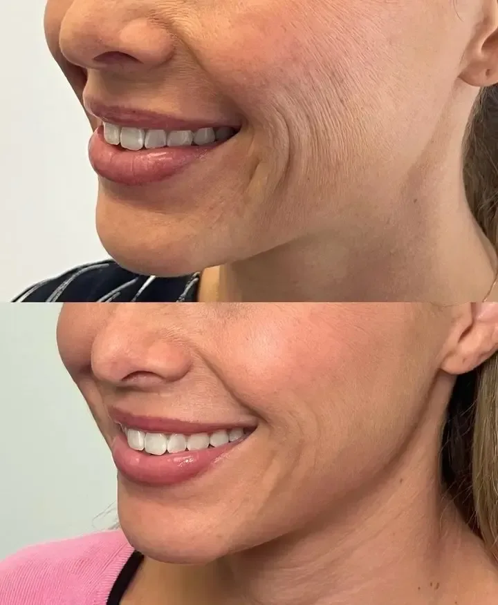 SKINVIVE — perioral smoothing, before and after