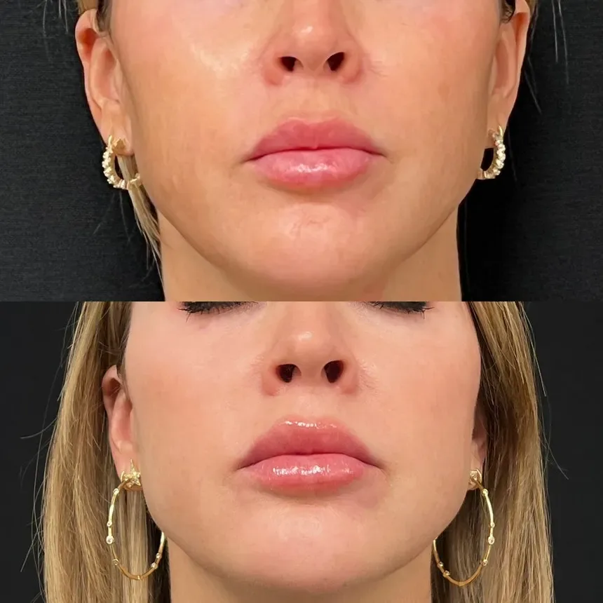Filler — lip and lower-face balance, before and after