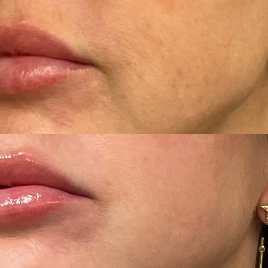 Filler — perioral hydration, before and after
