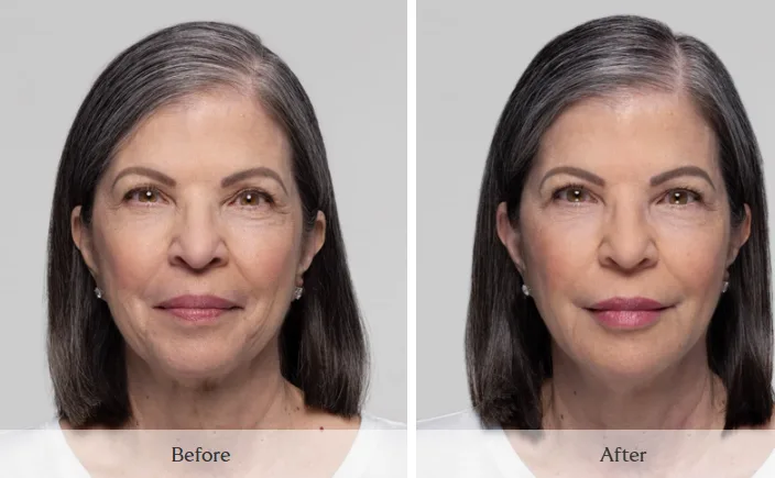 SKINVIVE — skin texture and glow, before and after